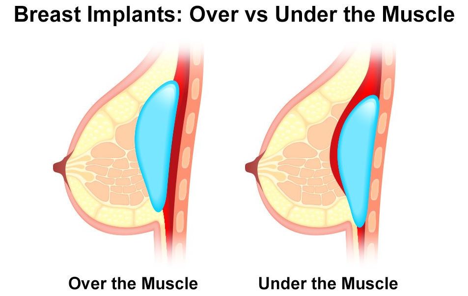 Імплант над м'язом (зліва) і під м'язом (справа)