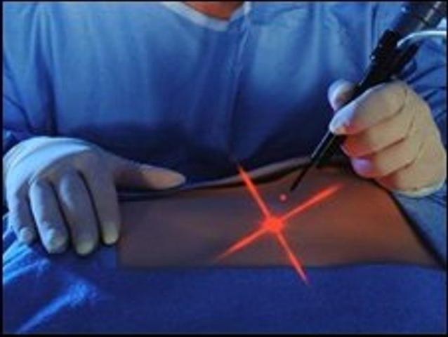 Лазерний ліполіз: делікатне видалення жирових відкладень