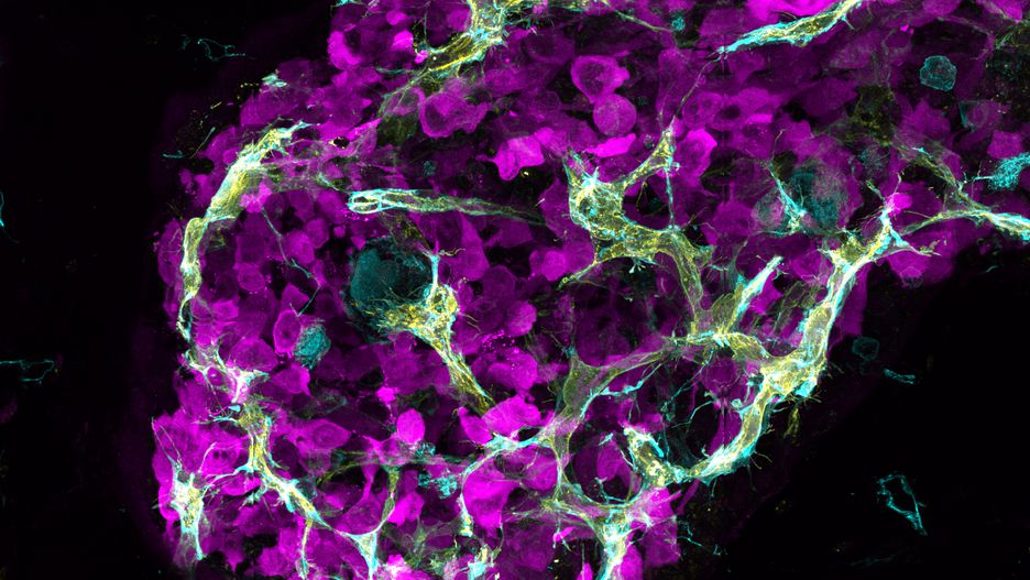«Електрифікація», автор Raymond Yip. Це 3D зображення, яке показує агресивну пухлину молочної залози у миші. Блакитні і жовті судини обволікають пурпурні ракові клітини.