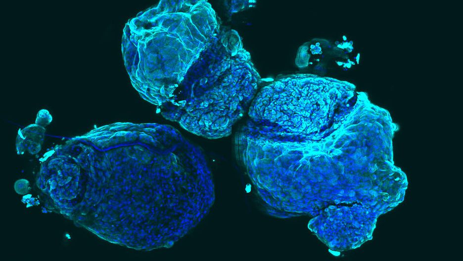 Cnidaria, автор Clare Weeden. На фото — стовбурові клітини дихальних шляхів у пацієнта з раком легенів.