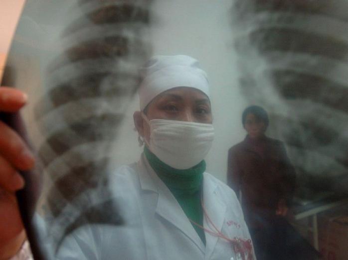 Перемогти туберкульоз в Європі в найближчі 85 років не вдасться — ВООЗ