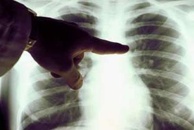МОЗ прогнозує зростання захворюваності на туберкульоз