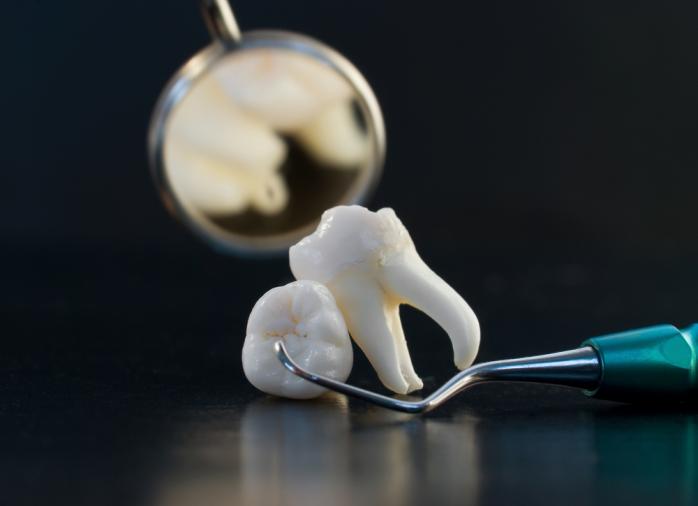 Перестаралась: в Киевской области стоматолог сломала пациенту нижнюю челюсть