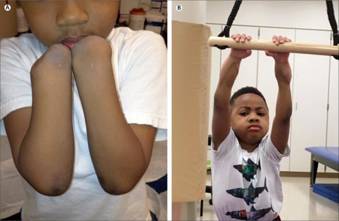 В США ученые подтвердили успех пересадки обеих рук 8-летнему ребенку (ВИДЕО)