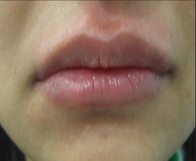 Увеличение верхней и нижней губы с использованием 1 мл гиалуроновой кислоты (после процедуры)