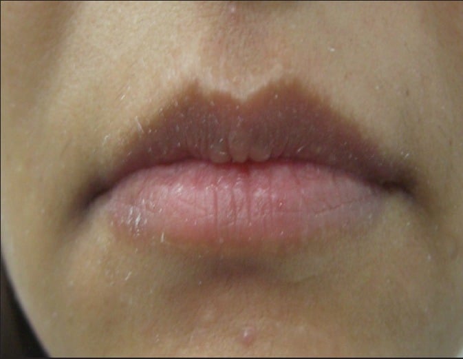 Увеличение верхней и нижней губы с использованием 1 мл гиалуроновой кислоты (перед процедурой)