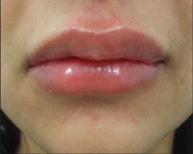 Набряк губ відразу після ін'єкції гіалуронової кислоти