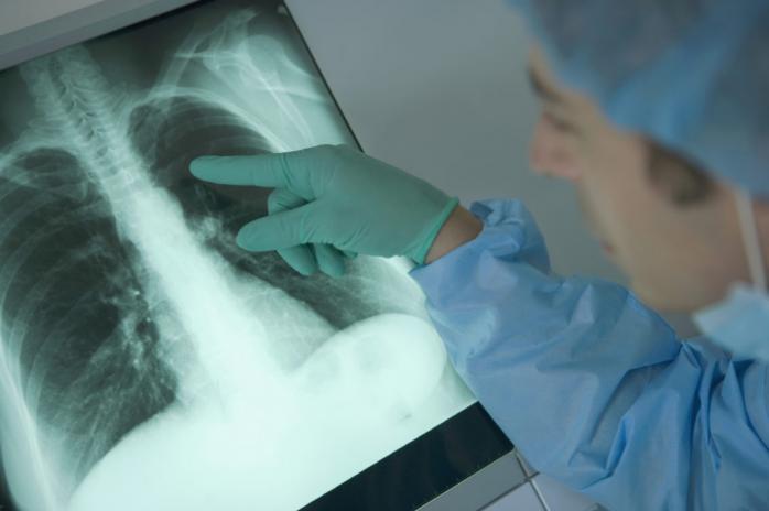 Туберкульоз в Україні: чи варто відмовлятися від флюорографії