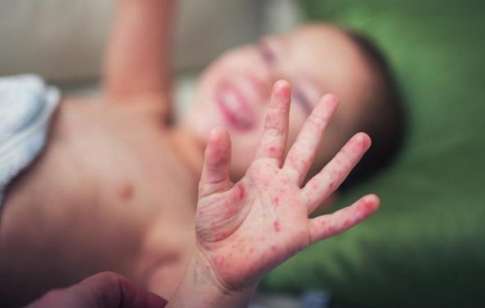 В Одессе от кори умер ребенок. Фото: avopix.com