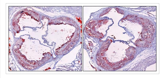 Изображения бляшки из артерий мышей с нормальным сном (слева) и с фрагментированным сном (справа). Фото: eurekalert.org