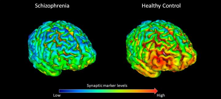 Сканирование мозга показывает, что 18 здоровых добровольцев (справа) имеют в среднем более высокие уровни (обозначены желто-красным) белка SV2A, чем 18 участников с шизофренией (слева), инфографика: Лондонский институт медицинских наук