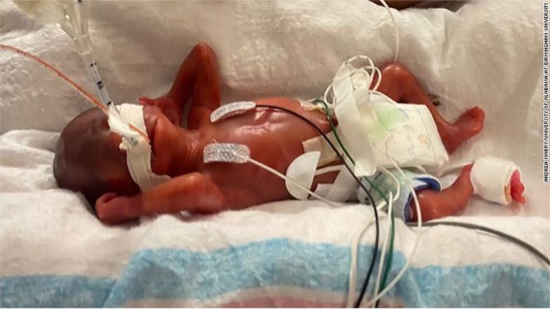 Вижив малюк, який народився на 21 тижні / Фото: UNIVERSITY OF ALABAMA AT BIRMINGHAM 