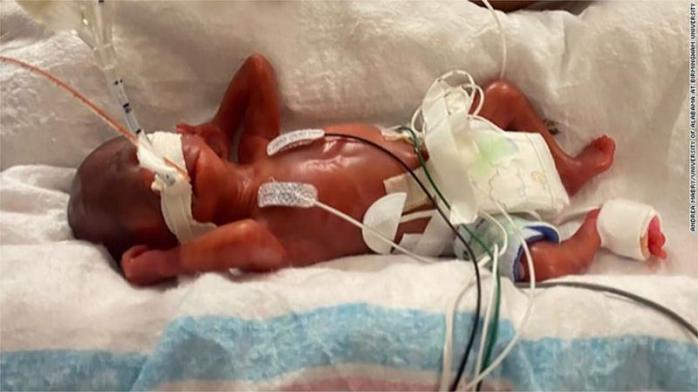 Новый рекорд Гиннесса — выжил малыш, родившийся на 21 неделе