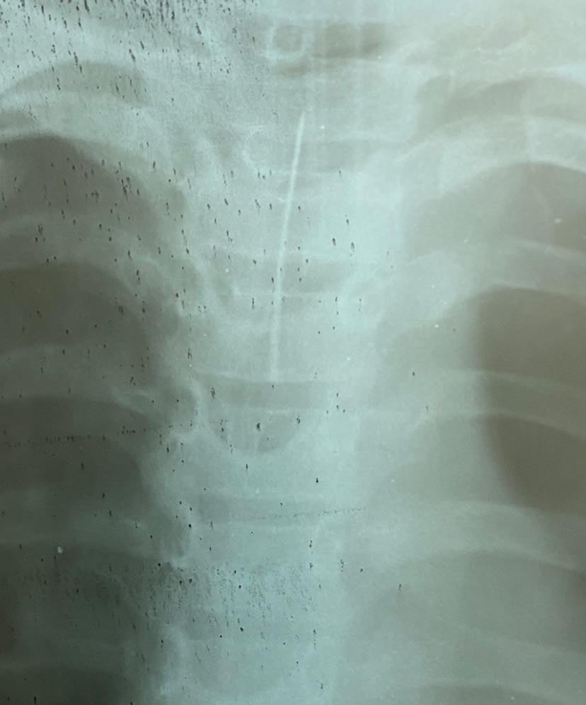 Хірурги витягли голку з горла дитини в Черкасах. Фото: Facebook