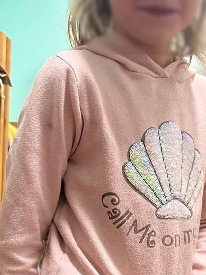 У 9-річної дівчинки на Київщині виявили січені рани - підозрюють виховательку дитбудинку