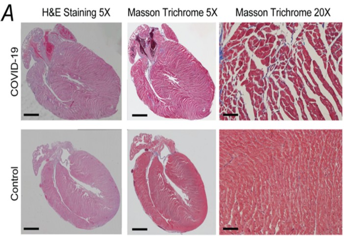 Серця мишей, інфікованих COVID-19, мають підвищений відсоток фіброзу та розширення волокон – загальний показник ранньої кардіоміопатії у мишей, джерело: Image courtesy of Andrew Marks.