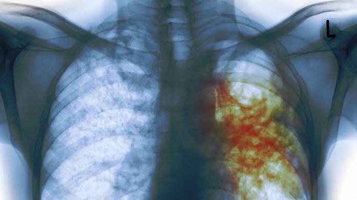 Чому в Україні росте захворюваність на туберкульоз