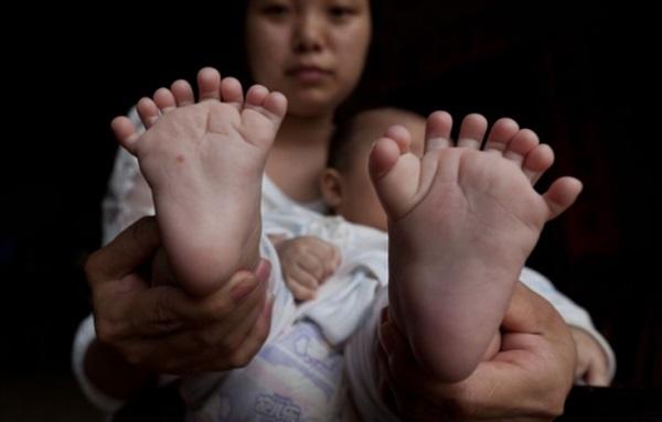 В Китае мальчик родился с 31 пальцем (ФОТО)